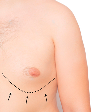 Лечение гинекомастии