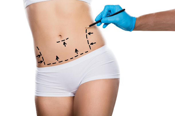 Абдоминопластика