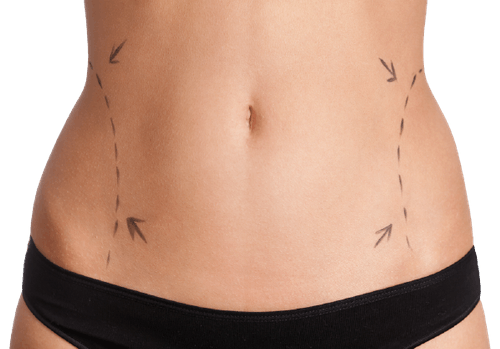 Липосакция