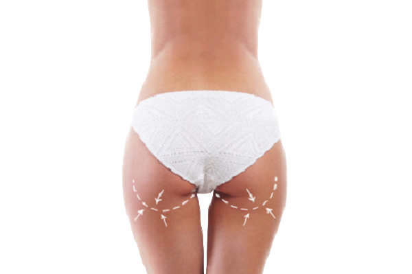 Глютенопластика 