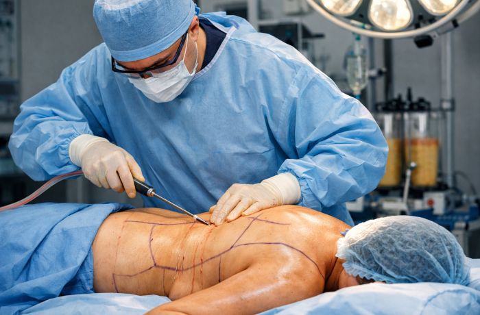 Липосакция спины