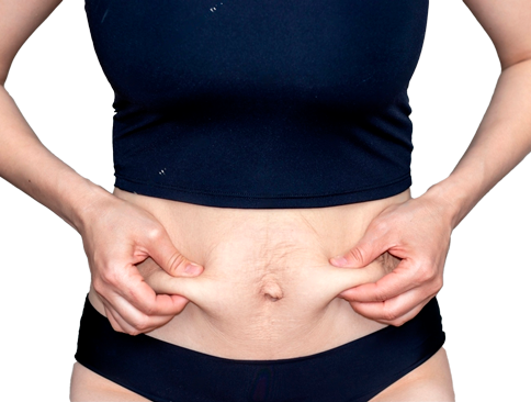 Диастаз без шрамов