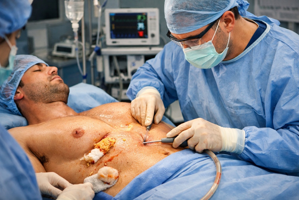 Ложная гинекомастия: особенности заболевания и методы коррекции